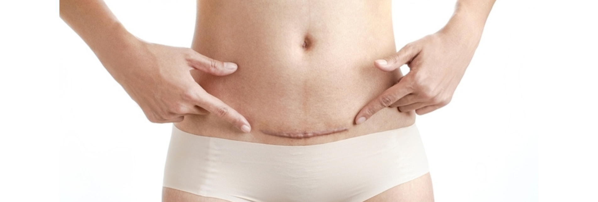 Κήλη μετά από καισαρική τομή