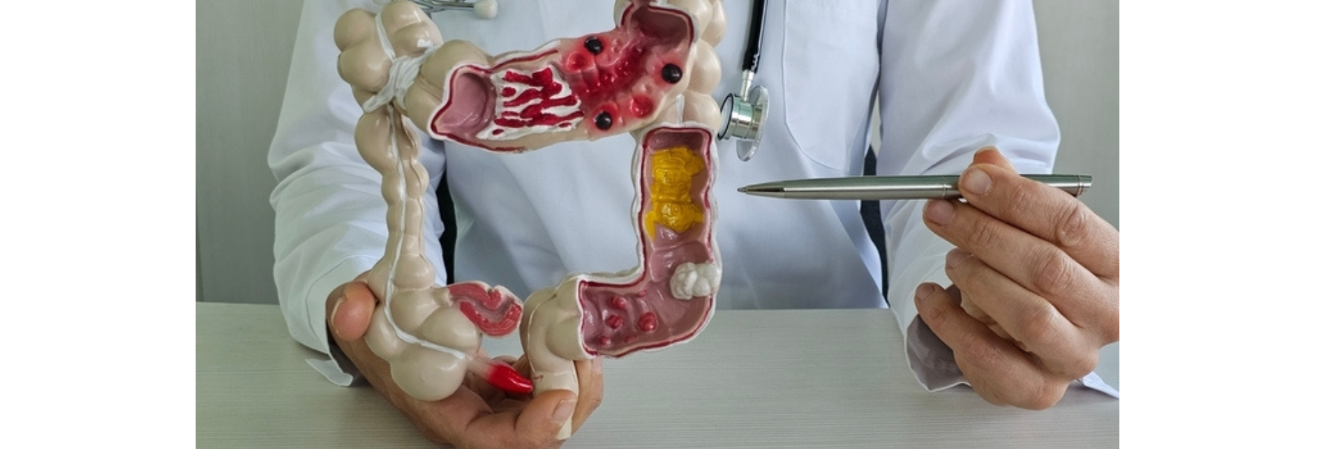 Χειρουργική αντιμετώπιση εκκολπωματίτιδας